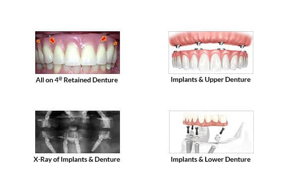All-on-4-Dental-Implants-in-Avondale