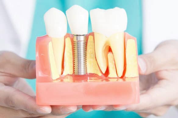 Dental-Implant-Placement-Methods