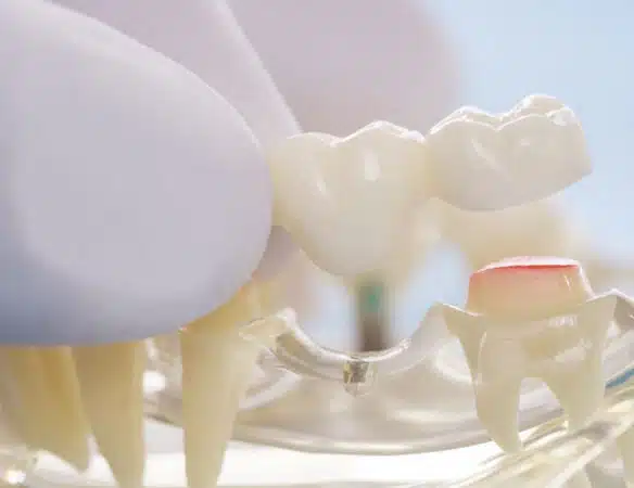 dental-restorations
