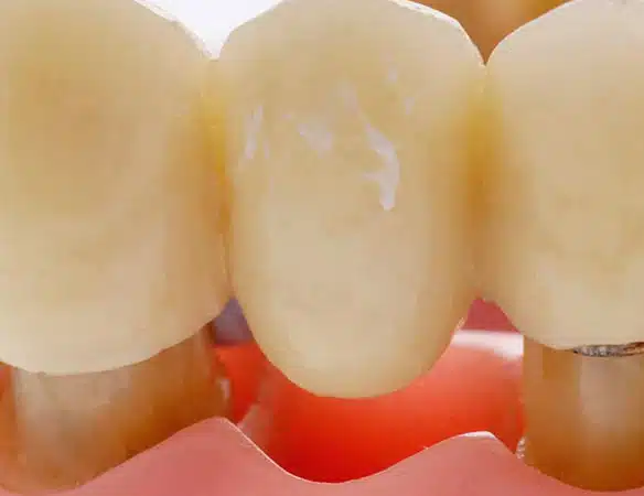 Removable-Dental-Bridge-Placement-Procedure