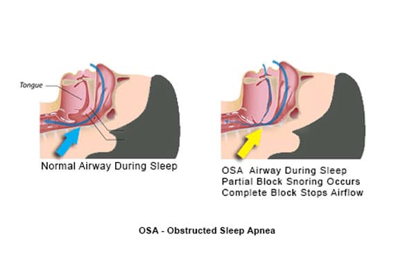 Signs-and-Symptoms-of-Sleep-Apnea