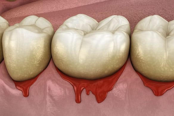 signs-of-periodontal-problems