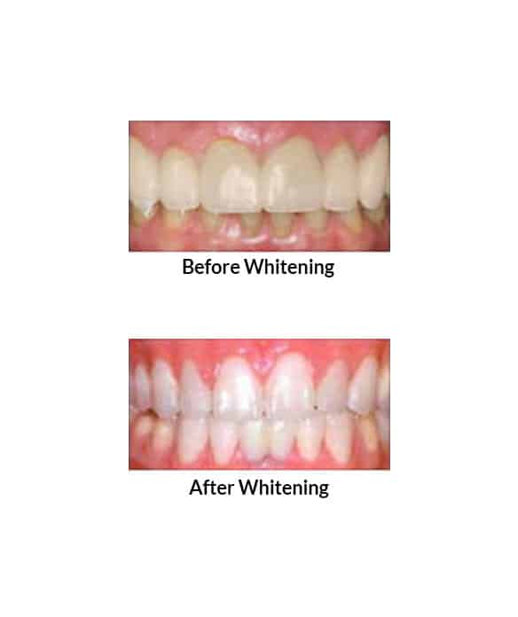 hydrogen peroxide baking soda teeth whitening before after