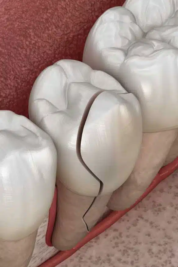 Can-a-Cracked-Tooth-be-Saved
