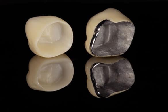 Ceramic-crowns-fused-to-metal-are-opaque