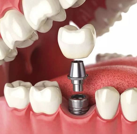 Dental-Implants-Options