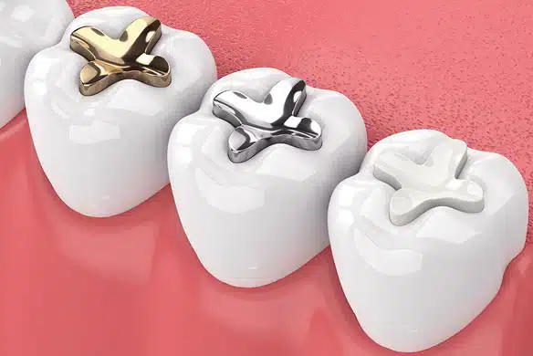img-Disadvantages-of-a-ceramic-dental-crown