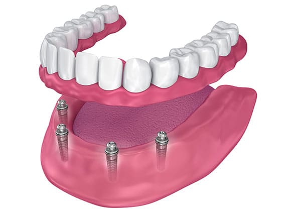Fixed-implant-retained-dentures-require