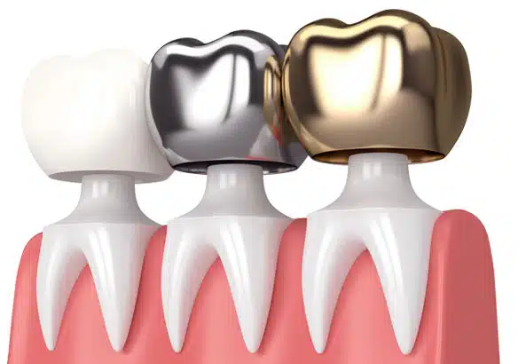 Other-dental-crown-options