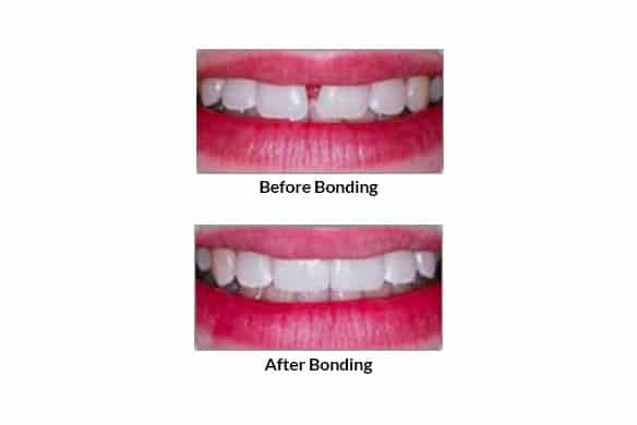 Dental Bonding and Veneering  Gentle Family Dentist Avondale and Dental  Implants